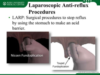 Laparoscopic Anti-reflux
Procedures
• LARP: Surgical procedures to stop reflux
by using the stomach to make an acid
barrier.
©2003 RUSH University Medical Center
 