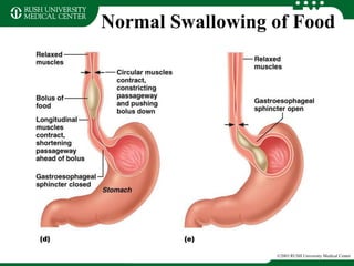 Normal Swallowing of Food
©2003 RUSH University Medical Center
 