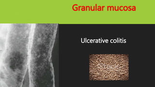 Granular mucosa
Ulcerative colitis
 