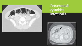 Pneumatosis
cystoides
intestinalis
 