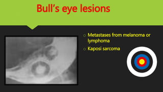 Bull’s eye lesions
o Metastases from melanoma or
lymphoma
o Kaposi sarcoma
 