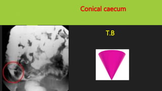 Conical caecum
T.B
 