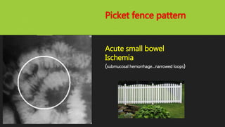 Picket fence pattern
Acute small bowel
Ischemia
(submucosal hemorrhage…narrowed loops)
 
