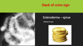 Stack of coins sign
Scleroderma – sprue
(Dilated loops)
 