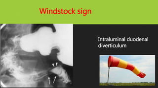 Intraluminal duodenal
diverticulum
Windstock sign
 