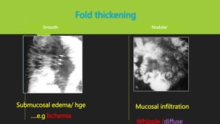 Fold thickening
Submucosal edema/ hge
….e.g Ischemia
Smooth
Mucosal infiltration
Whipple /diffuse
Nodular
 