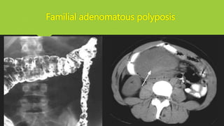 Familial adenomatous polyposis
 