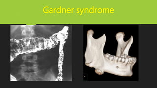 Gardner syndrome
 