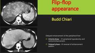 Flip-flop
appearance
Budd Chiari
Delayed enhancement of the peripheral liver
 Arterial phase -- peripheral hypodensity and
central enhancement.
 Delayed phase-- reversal of enhancement
pattern.
 