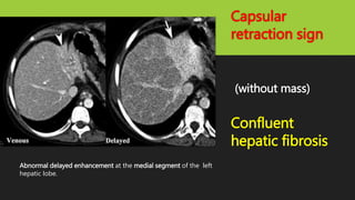 Capsular
retraction sign
(without mass)
Confluent
hepatic fibrosis
Abnormal delayed enhancement at the medial segment of the left
hepatic lobe.
 