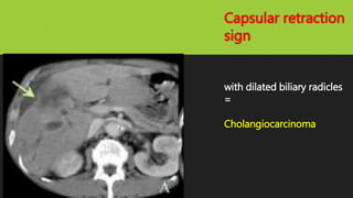Capsular retraction
sign
with dilated biliary radicles
=
Cholangiocarcinoma
 