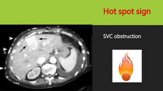 Hot spot sign
SVC obstruction
 