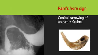 Ram’s horn sign
Conical narrowing of
antrum = Crohns
 