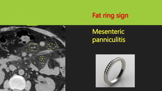 Fat ring sign
Mesenteric
panniculitis
 