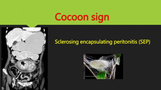 Cocoon sign
Sclerosing encapsulating peritonitis (SEP)
 