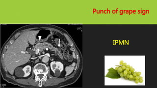 Punch of grape sign
IPMN
 