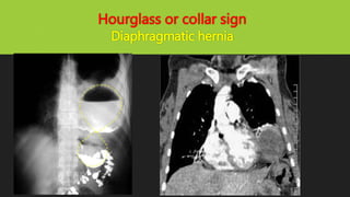 Hourglass or collar sign
Diaphragmatic hernia
 