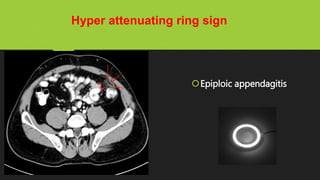 Epiploic appendagitis
Hyper attenuating ring sign
 