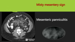 Misty mesentery sign
Mesenteric panniculitis
 