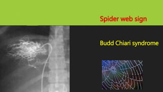 Spider web sign
Budd Chiari syndrome
 