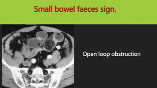 Small bowel faeces sign.
Open loop obstruction
 