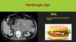 Hamburger sign
NHL
(Lymph nodes encase mesenteric
vessels)
 