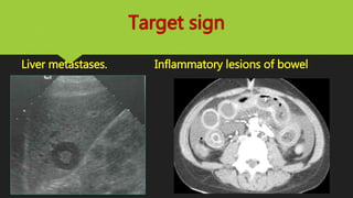 Target sign
Liver metastases. Inflammatory lesions of bowel
 
