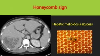 Honeycomb sign
Hepatic melioidosis abscess
 