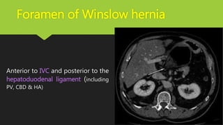 Foramen of Winslow hernia
Anterior to IVC and posterior to the
hepatoduodenal ligament (including
PV, CBD & HA)
 