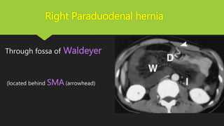 Right Paraduodenal hernia
Through fossa of Waldeyer
(located behind SMA (arrowhead)
 