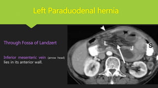 Left Paraduodenal hernia
Through Fossa of Landzert.
Inferior mesenteric vein (arrow head)
lies in its anterior wall.
 