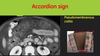 Accordion sign
Pseudomembranous
colitis
 