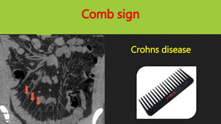 Comb sign
Crohns disease
 