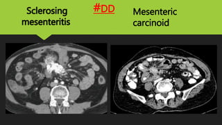 Sclerosing
mesenteritis
Mesenteric
carcinoid
#DD
 
