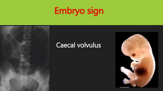 Embryo sign
Caecal volvulus
 
