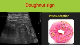 Doughnut sign
Intussusception
 