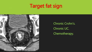 Target fat sign
Chronic Crohn’s.
Chronic UC.
Chemotherapy.
 