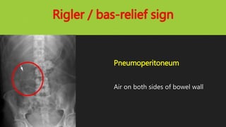 Rigler / bas-relief sign
Pneumoperitoneum
Air on both sides of bowel wall
 