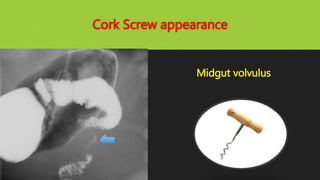 Cork Screw appearance
Midgut volvulus
 