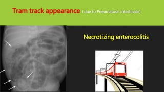 Tram track appearance ( due to Pneumatosis intestinalis)
Necrotizing enterocolitis
 