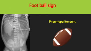 Foot ball sign
Pneumoperitoneum.
 