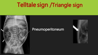 Telltale sign /Triangle sign
Pneumoperitoneum
 