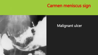 Carmen meniscus sign
Malignant ulcer
 