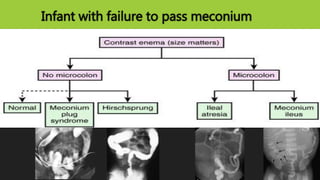 Infant with failure to pass meconium
 