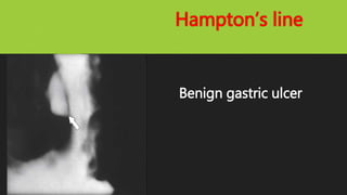 Hampton’s line
Benign gastric ulcer
 