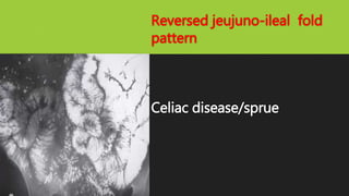 Reversed jeujuno-ileal fold
pattern
Celiac disease/sprue
 