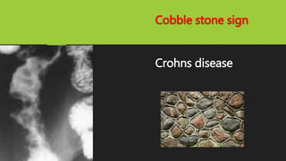 Cobble stone sign
Crohns disease
 
