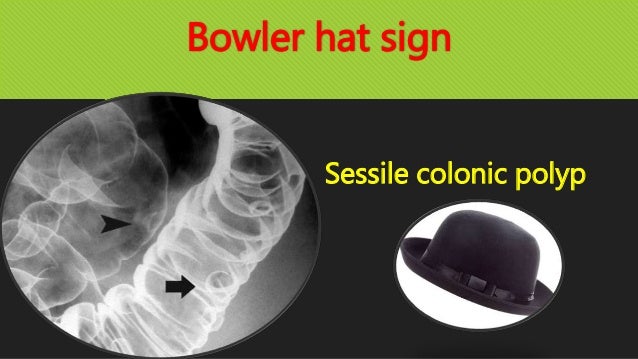 bowler hat sign