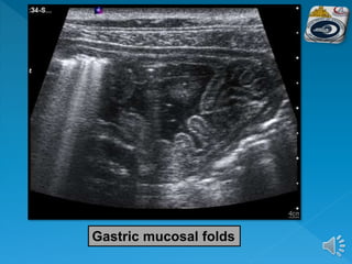 Gastric mucosal folds
 