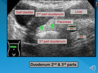 Duodenum 2nd & 3rd parts
Gall bladder
2nd part duodenum
Liver
Pancreas
3rd part duodenum
SMV
SMA
 